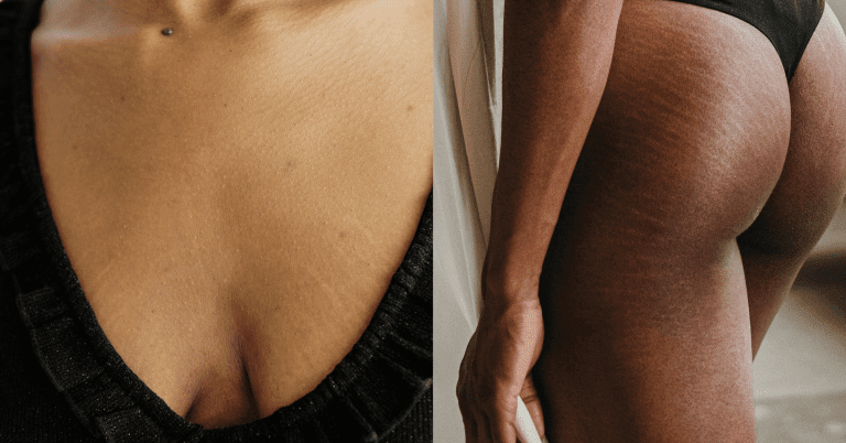 get rid of stretchmark in 30 days